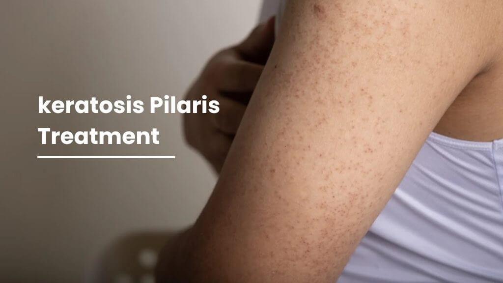 keratosis pilaris treatment products manufacturer